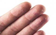 手掌脱皮怎么回事 受6大因素影响