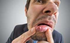 泉州男士引起口腔溃疡原因有哪些 应对口腔溃疡